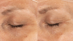 eye transformation