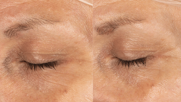 eye transformation